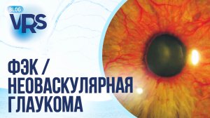 Сахарный диабет / Диабетическая ретинопатия/ Факоэмульсификация катаракты /Неоваскулярная глаукома