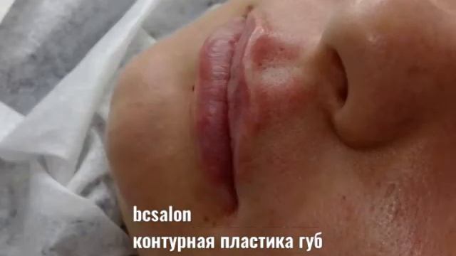 Контурная пластика губ|Процедура|Москва