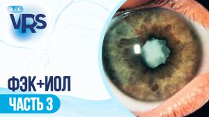 Хирургия катаракты / Увеит