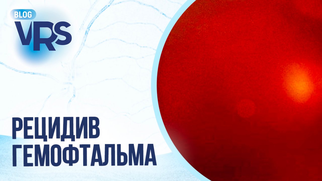 Сахарный диабет / Диабетическая ретинопатия / Рецидив гемофтальма