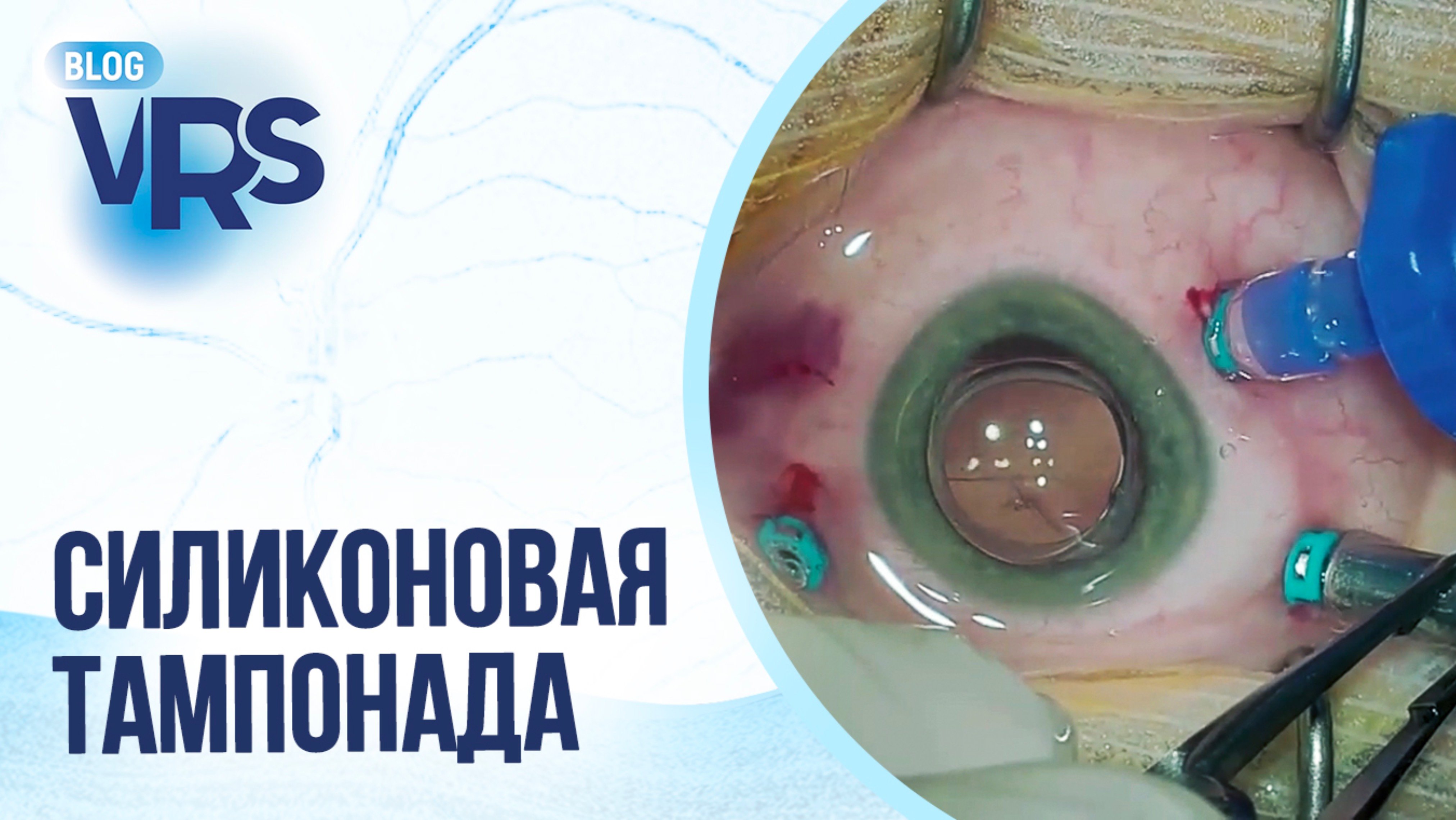 Сахарный диабет / Диабетическая ретинопатия / Тампонада силиконовым маслом и ПФОС
