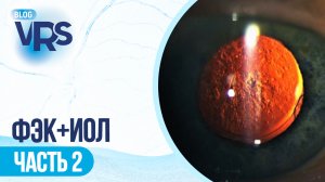 Хирургия катаракты / Задний капсулорексис vs лазерная дисцизия