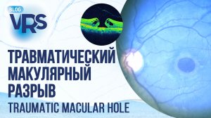 Травматический макулярный разрыв сетчатки. Стоит ли ждать? | Traumatic macular hole.