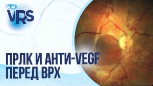 Сахарный диабет / Диабетическая ретинопатия / ПРЛК и анти-vegf перед хирургией