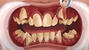 ASMR dental treatment animation | teeth treatment asmr | Braces treatment - teeth tapping asmr