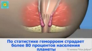 легкий геморрой