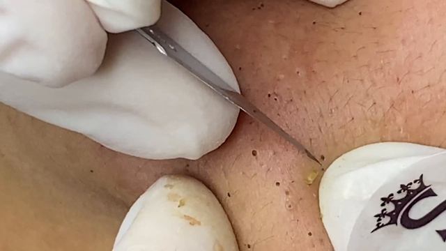 Blackhead On The Skin Of Young Girl | Làm Sạch Mụn Đầu Đen Trên Da Cô Gái Trẻ - SacDepSpa#250 смотреть онлайн