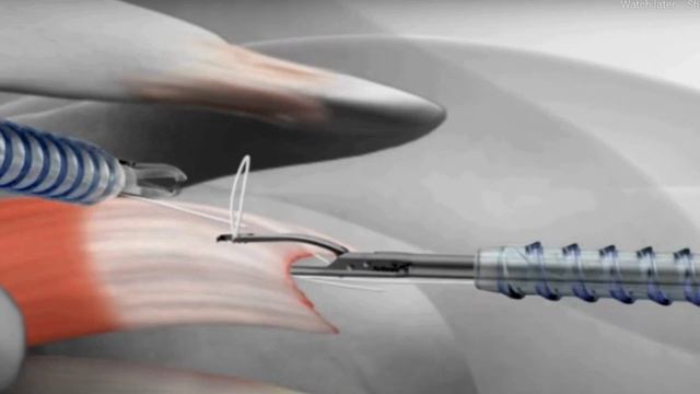 Animated Live Surgery - Rotator Cuff Repair Surgery | Dr. Amyn Rajani | Oaks Clinic смотреть онлайн