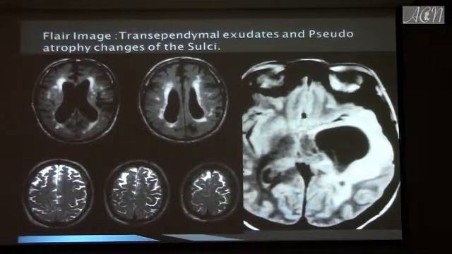 MRI CT Findings In Hydrocephalus with Increased Intracranial Pressure by Hamza Alsayouf