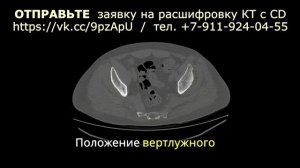 ИМПИДЖМЕНТ синдром и ДЕФОРМИРУЮЩИЙ ОСТЕОАРТРОЗ тазобедренного сустава 3 степени на расшифровке КТ