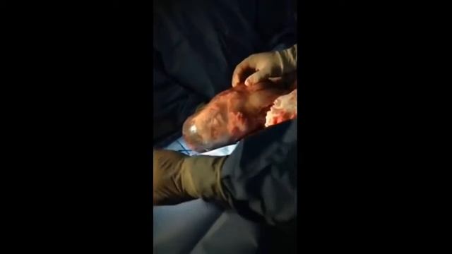 Baby born with amniotic sac intact