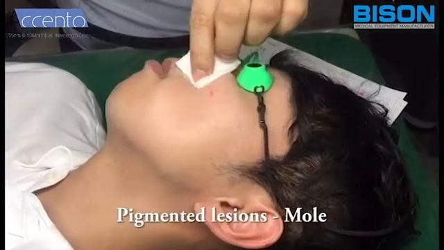 Alexandrite & NdYAG Laser Clinical Video-755nm/1064nm Long pulsed Laser(ACCENTO)_BISON MEDICAL смотреть онлайн