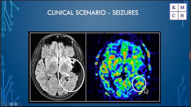 PART-2  MRI PERFUSION ASL  |CLINICAL SCENARIOS|