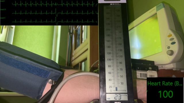 Manual Blood Pressure Examination /w Tachycardia and Irregular HeartBeat