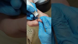 Удаление межпальцевой стержневой мозоли