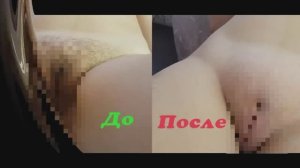 Шугаринг #3 глубокого бикини 18+ . Шугаринг межъягодичной складки. | Waxin