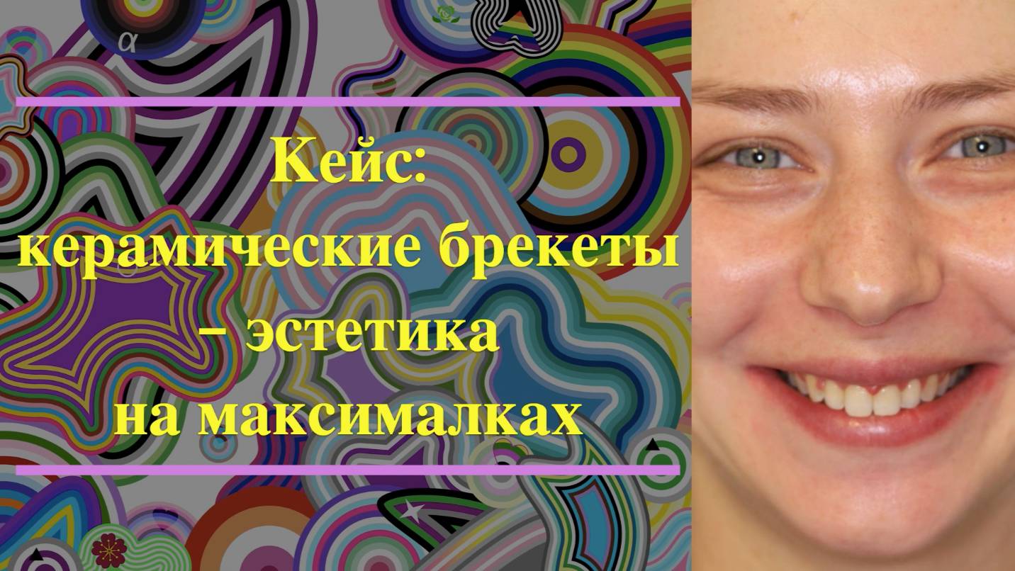 💎Кейс: керамические брекеты - эстетика на максималках