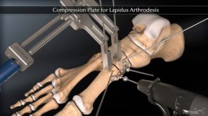 Compression Plate for Lapidus Arthrodesis