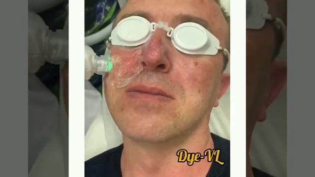 Лазерное лечение розацеи с помощью лазера DYE-VL