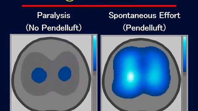 The dark side of spontaneous breathing in ARDS. Yoshida Takeshi