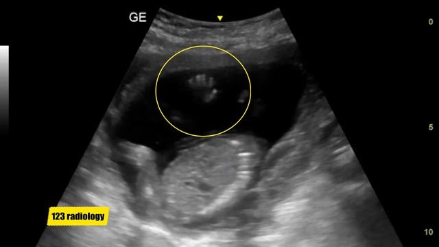 Fetal Hand | 18 weeks pregnancy смотреть онлайн