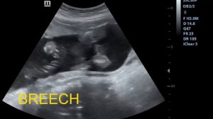 Ultrasound Showing Baby Boy in breech Presentation