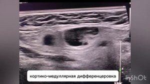 Лимфатические узлы шеи