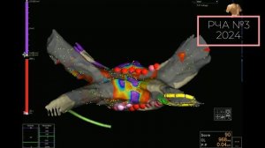 Повторная РЧА фибрилляции предсердий. Причина возврата аритмии через 8 лет после операции.