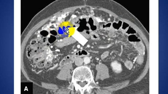 Peritoneal Calcification смотреть онлайн