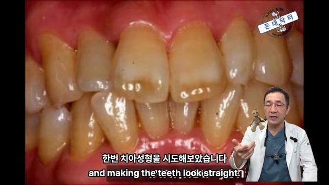 신의 손 치과의사라면 라미네이트 안해도 치아교정 효과 냅니다