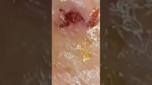 Tungiasis Severa-exploration