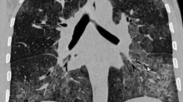 PCP Pneumonia por pneumocystis Jirovecii смотреть онлайн