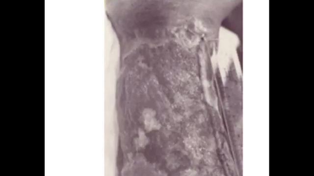 ULCERAS VARICOSAS смотреть онлайн