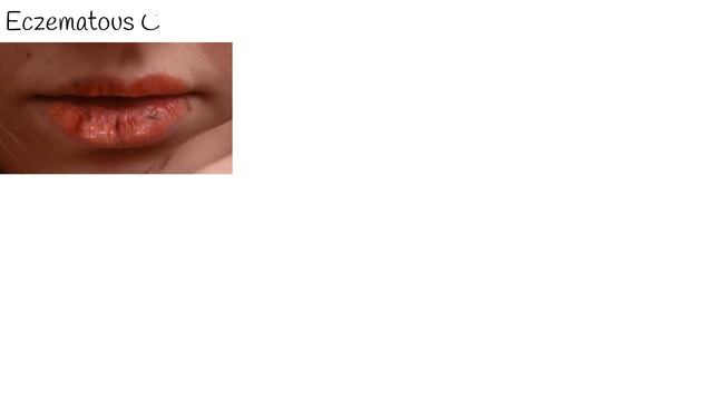 Dry and cracked lips - understanding Chapped lips, lips lesion Types смотреть онлайн