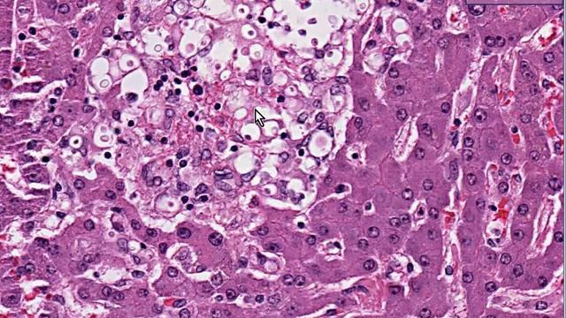 Histopathology Liver --Cryptococcosis смотреть онлайн