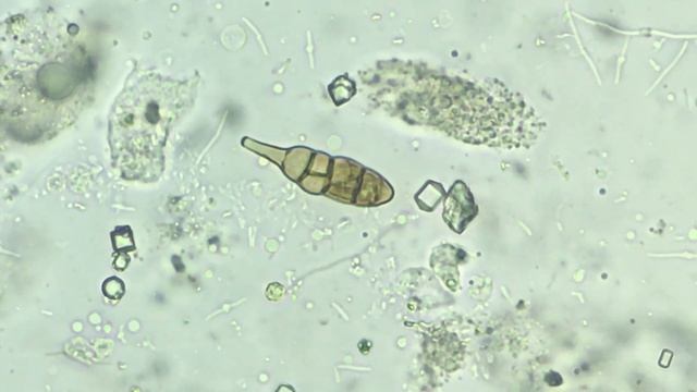 Alternaria microconidia - contaminant in urine