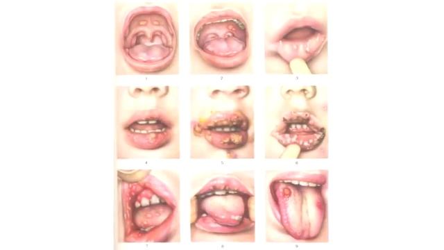 ПРЕКРАСНАЯ ЛЕКЦИЯ О ГРИБКАХ В НАШЕМ ОРГАНИЗМЕ И КАК ОТ НИХ ИЗБАВИТЬСЯ смотреть онлайн