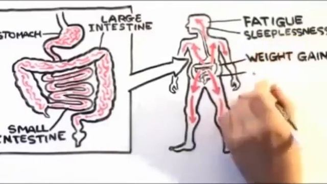 Sugar cause of Candida Candida cause of Cancer смотреть онлайн