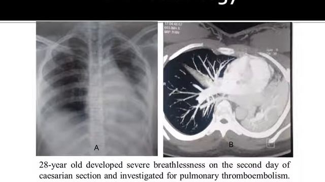 Allergic Bronchopulmonary Aspergillosis смотреть онлайн