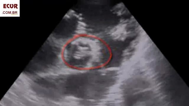 The ultimate guide to Endocarditis Echocardiography. #echocardiography смотреть онлайн