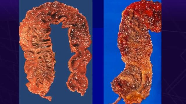 Enfermedad Inflamatoria Intestinal смотреть онлайн