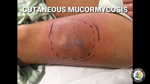 Mucor mycosis || મ્યુકોર માયકોસીસ || Fungal infection || Rare disease || Hindi смотреть онлайн