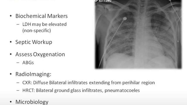 Pneumocystis смотреть онлайн