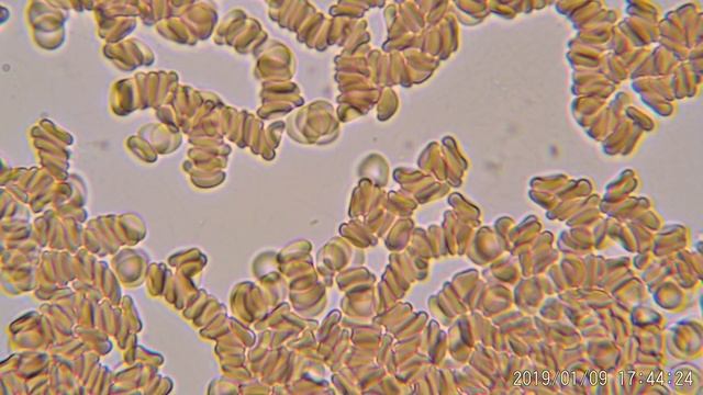 Нигер аспергилиус в капле крови смотреть онлайн