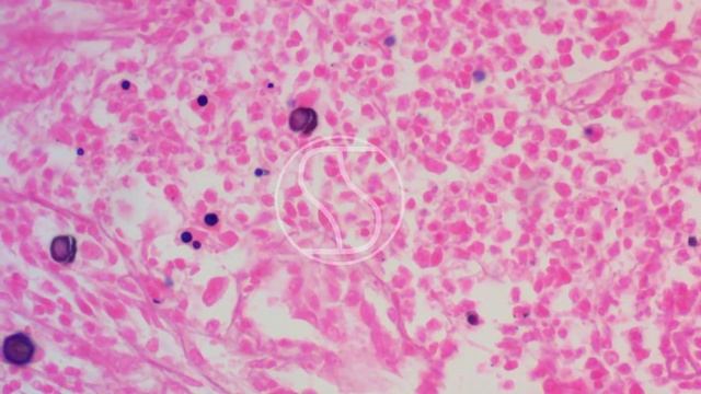 Coccidioides immitis under the microscope with GMS-Haematoxylin and Eosin stain смотреть онлайн