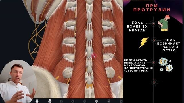 Миофасциальный Синдром и Грыжа Диска. Очень наглядное обьяснение