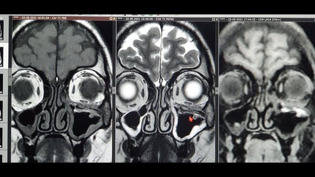 PART 1 | MUCOR Fungus SURGERY with Detailed MRI concepts| Orbital Floor Erosion & Orbital extension