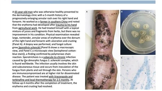 Aspergillus, Sporothrix, and Mucor Infections -- Aliyah Baluch, MD смотреть онлайн