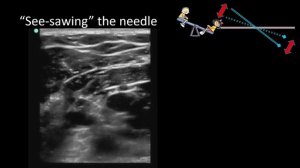 Общие вопросы регионарной анестезии под УЗИ 2 часть