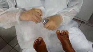 Frieira, pé de atleta, Tinea Pedis, tratamento caseiro!